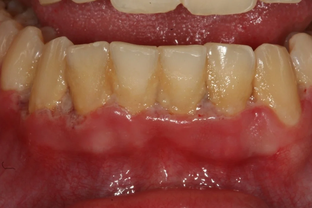 Enfermedad periodontal con inflamación de encías antes del tratamiento en Clínica Dental Domínguez & Morales, Chamberí, Madrid