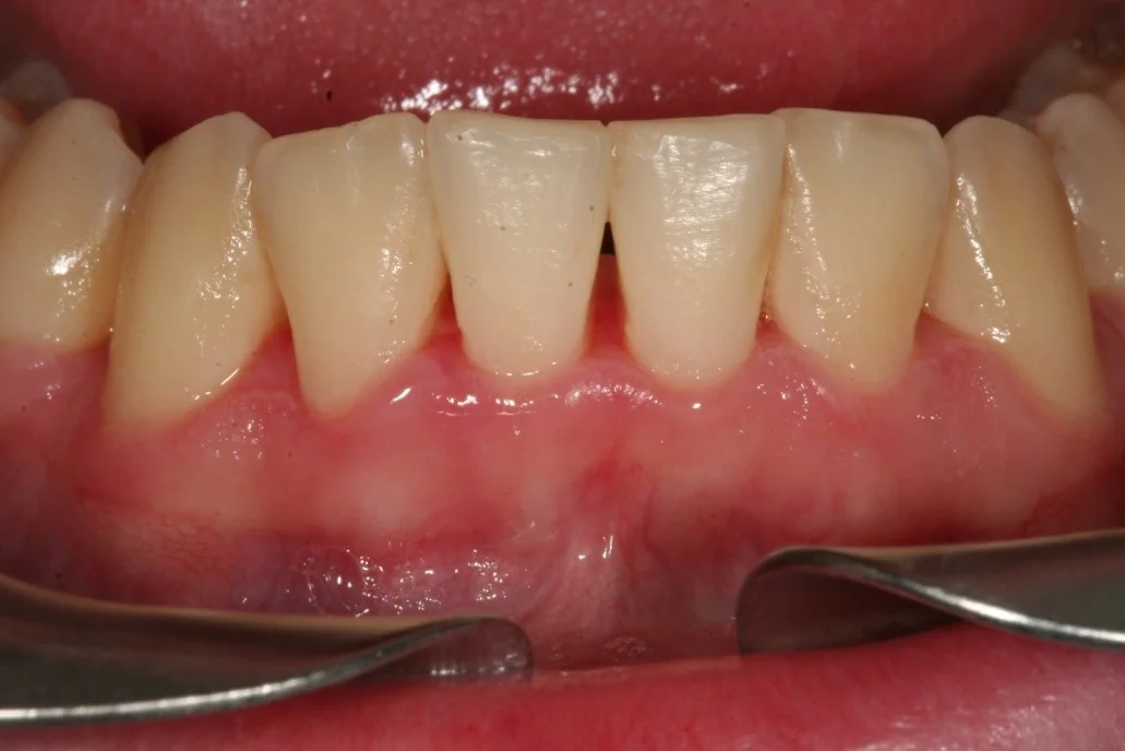 Encías sanas tras el tratamiento periodontal en Clínica Dental Domínguez & Morales, Chamberí, Madrid