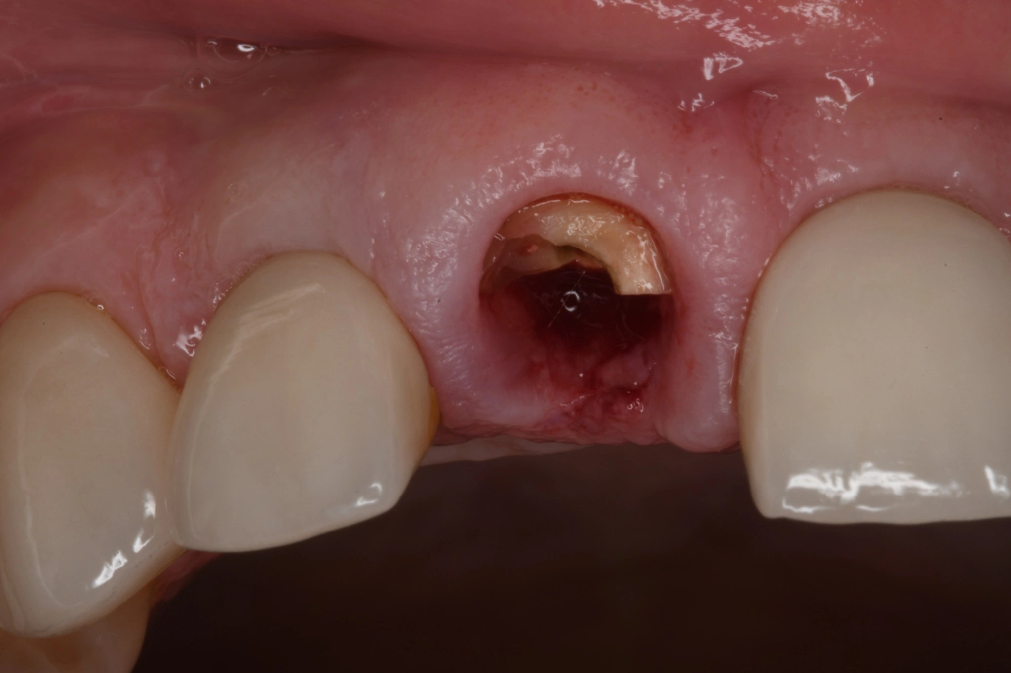 Fractura dental antes de colocar el implante en Clínica Dental Domínguez & Morales, Chamberí, Madrid