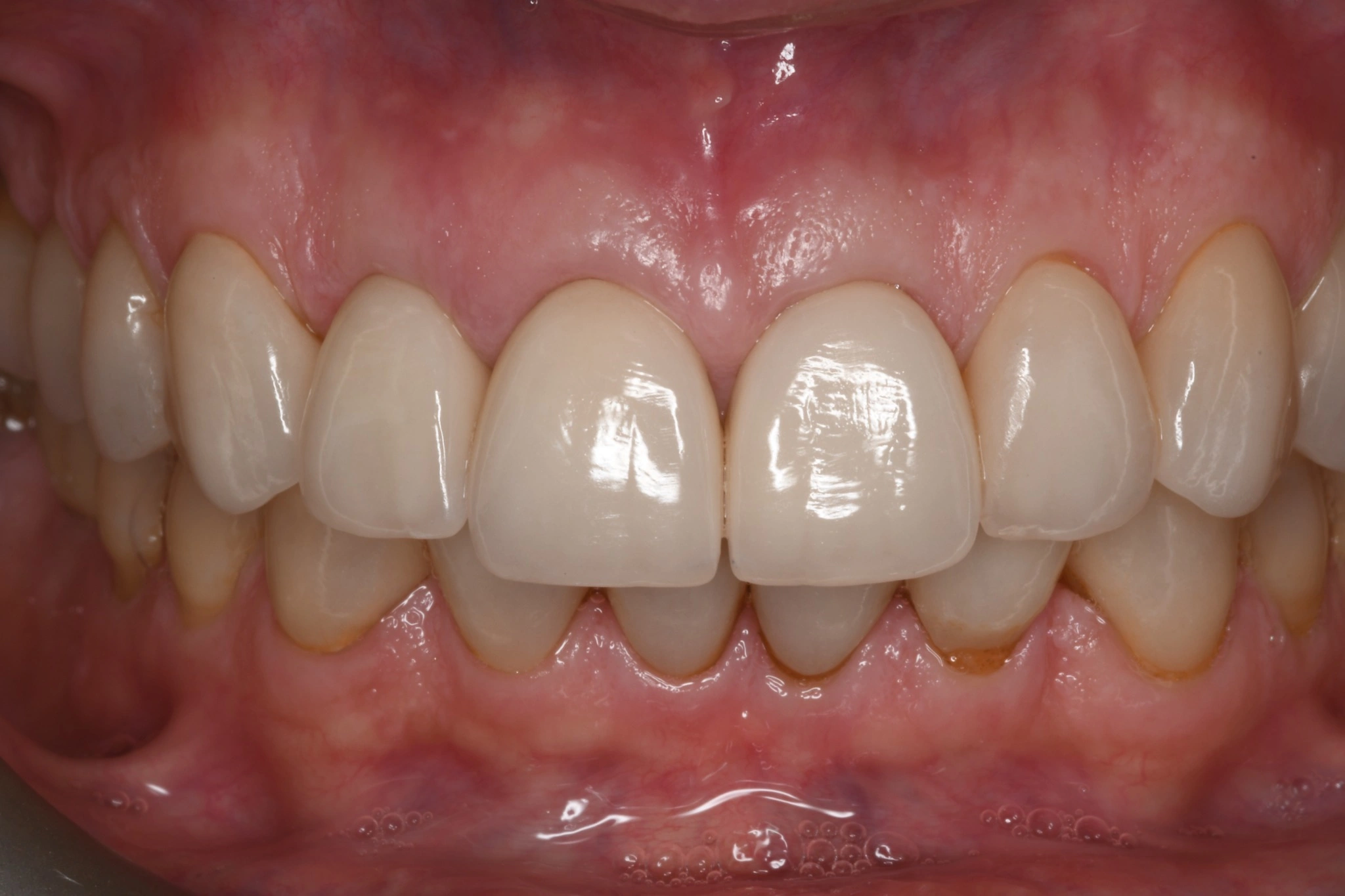 Implante dental con corona, resultado después, en Clínica Dental Domínguez & Morales, Chamberí, Madrid