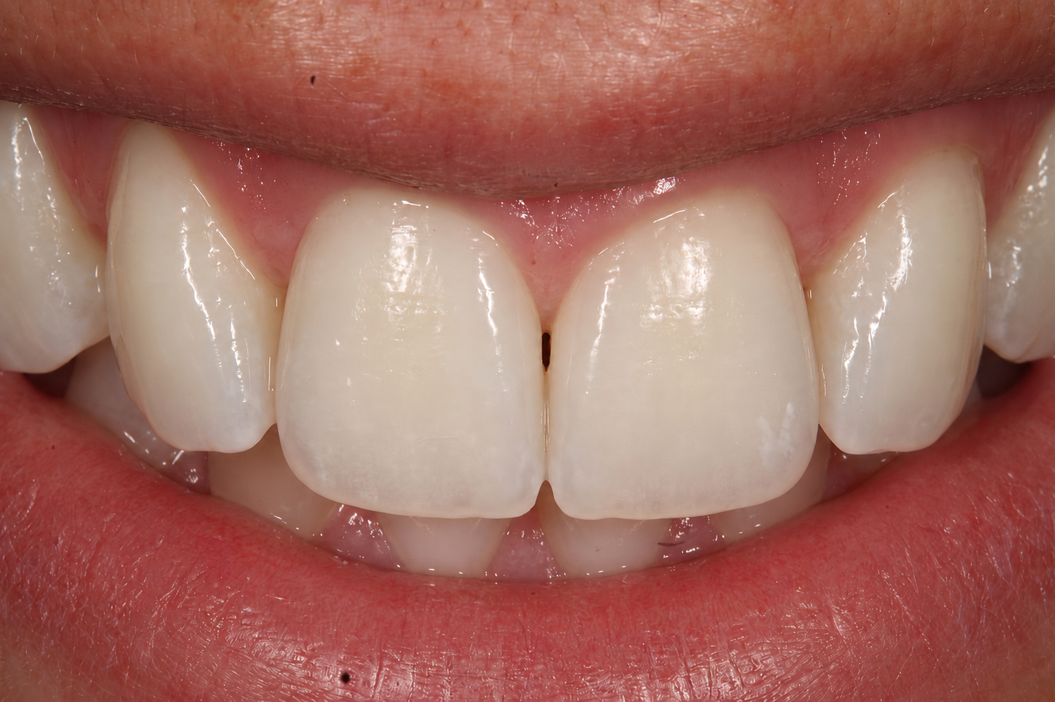 Blanqueamiento dental, resultado después, en Clínica Dental Domínguez & Morales, Chamberí, Madrid