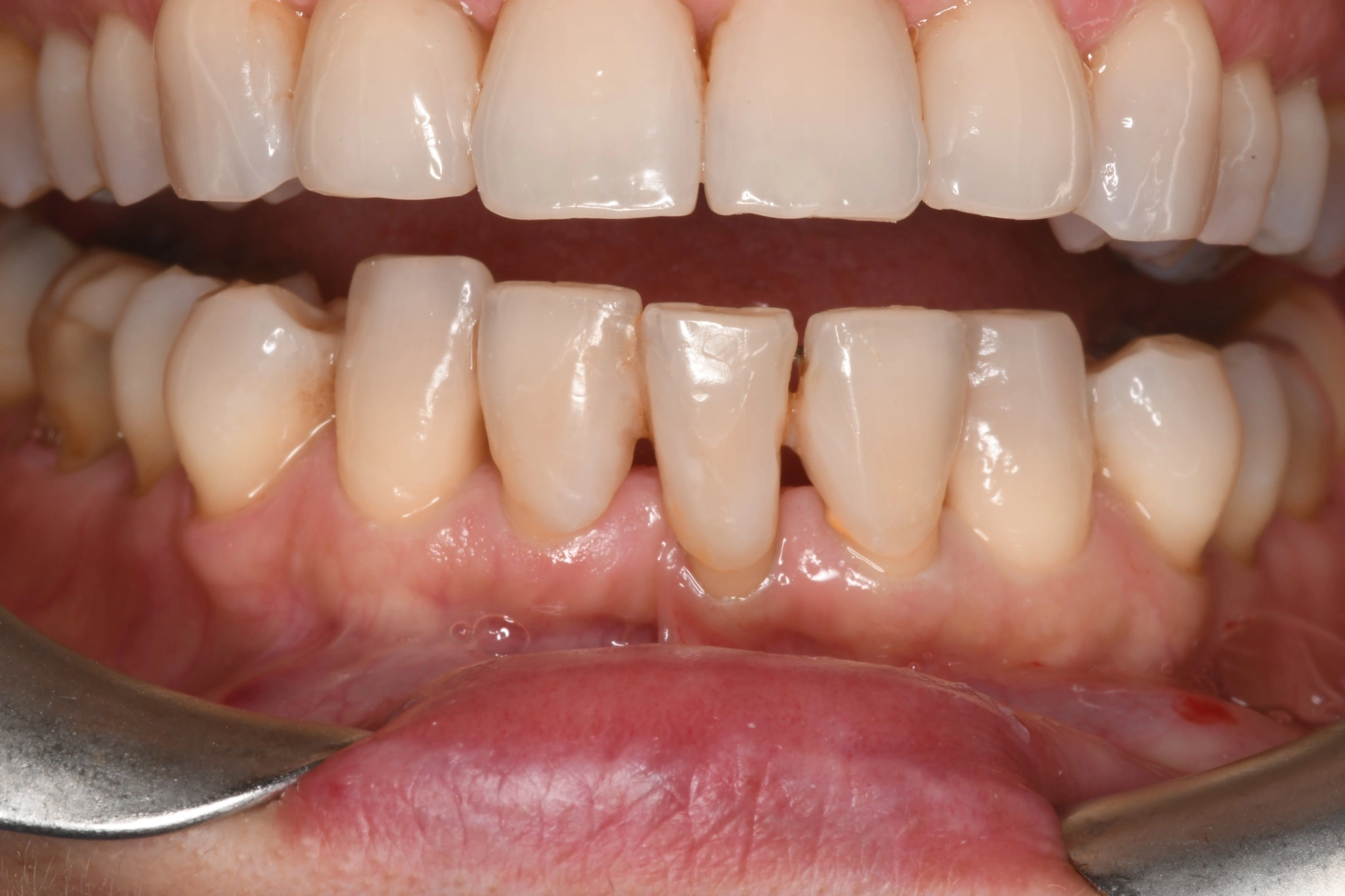 Sonrisa con troneras visibles antes del tratamiento con carillas de composite en Clínica Dental Domínguez & Morales, Chamberí, Madrid