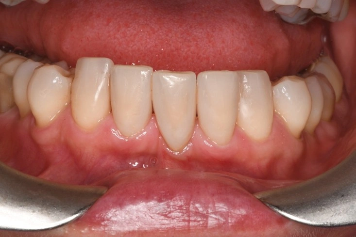 Sonrisa armonizada tras tratamiento con carillas de composite directo en Clínica Dental Domínguez & Morales, Chamberí, Madrid