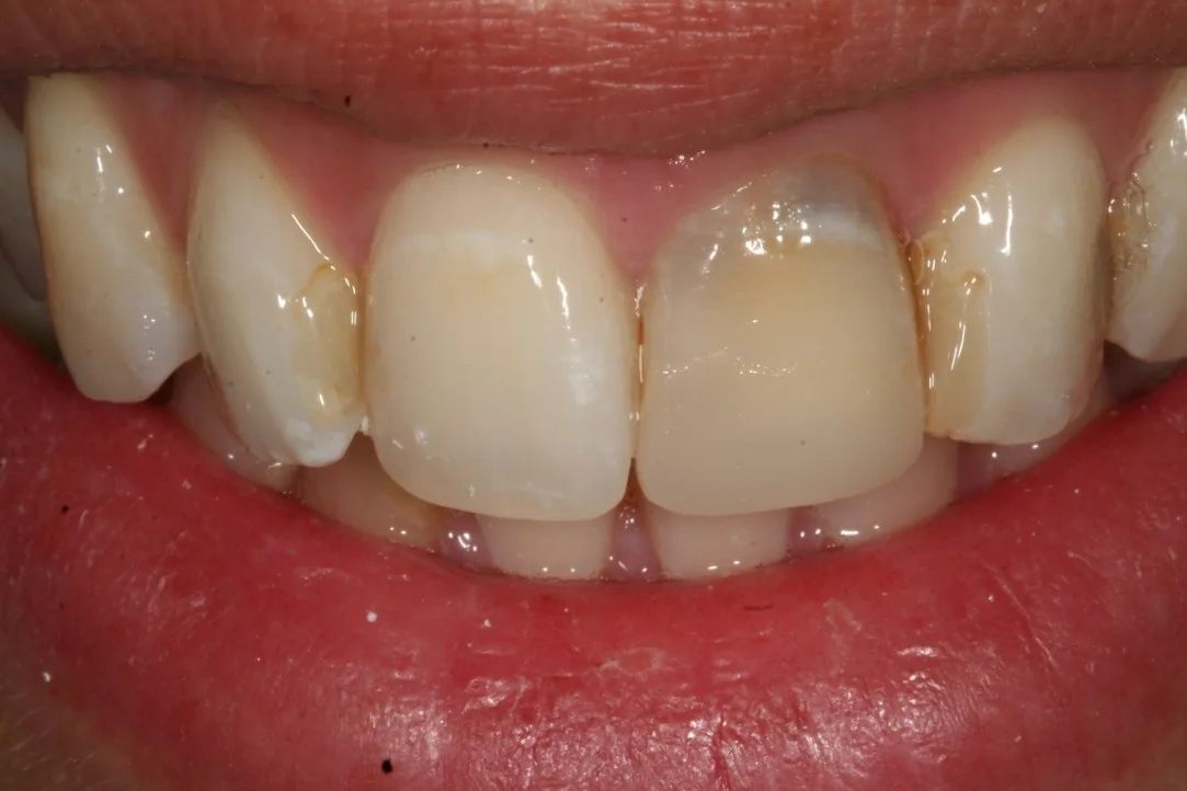 Color dental inicial antes del blanqueamiento en Clínica Dental Domínguez & Morales, Chamberí, Madrid