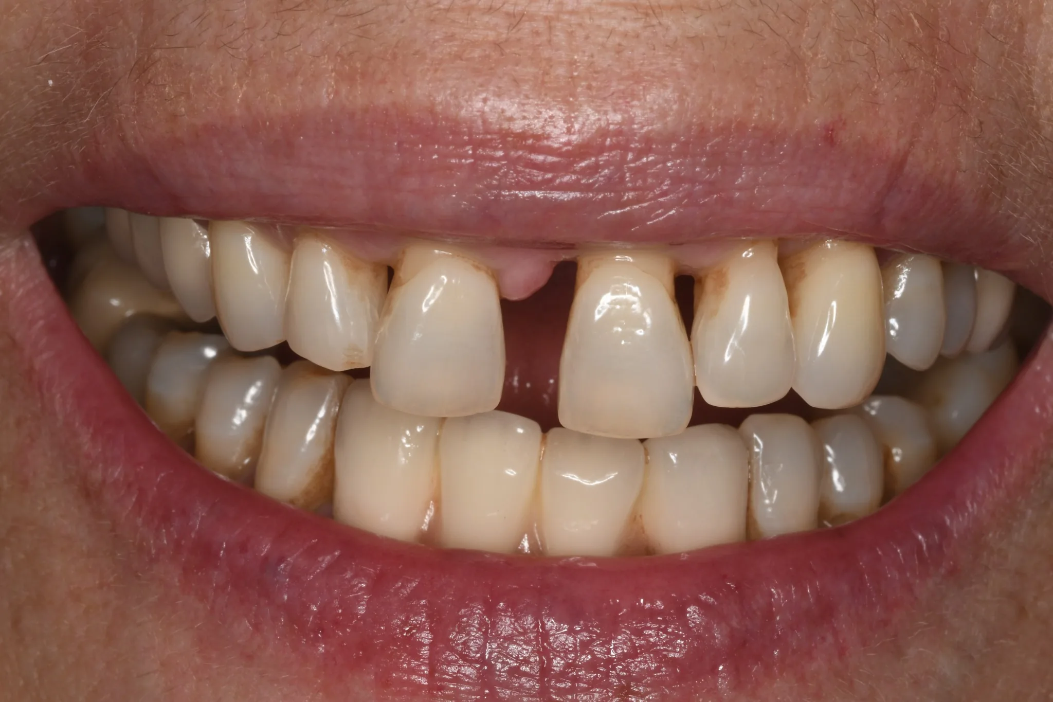 Triángulos negros y espacios entre dientes antes del tratamiento en Clínica Dental Domínguez & Morales, Chamberí, Madrid