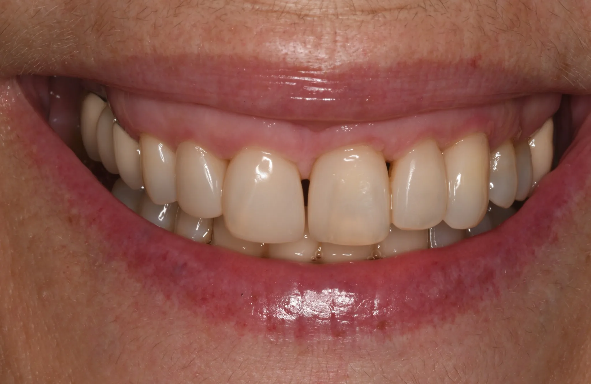 Cierre de triángulos negros con técnica Bioclear, resultado después, en Clínica Dental Domínguez & Morales, Chamberí, Madrid