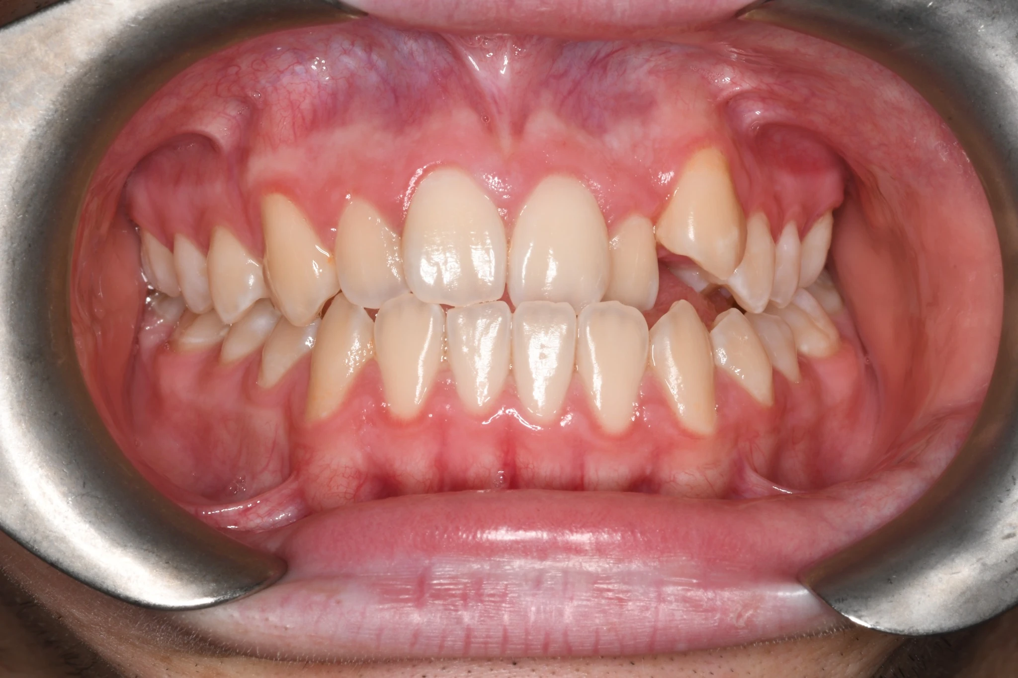Sonrisa con apiñamiento dental antes del tratamiento de ortodoncia con alineadores invisibles en Clínica Dental Domínguez & Morales, Chamberí, Madrid