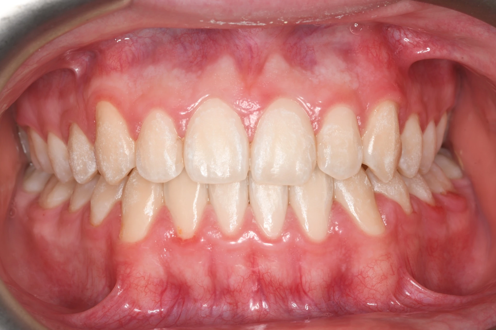Sonrisa alineada tras tratamiento de ortodoncia invisible con alineadores en Clínica Dental Domínguez & Morales, Chamberí, Madrid